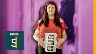 Womens Health PCOS condition without a cure  BBC Stories [upl. by Sedda481]