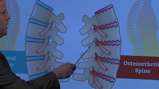 CERVICAL SPONDYLOSIS Causes Symptoms and Treatment NO SURGERY [upl. by Nesnaj]