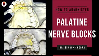 Palatal Anesthesia Techniques l Greater Palatine Nerve Block l Nasopalatine Nerve Block [upl. by Leveroni]