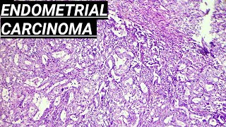 Digital Surgical Pathology 38 Endometrial Stromal Sarcoma [upl. by Myca]