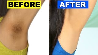 How To Lighten Dark Underarms Permanently  Skincare Routine  ShrutiArjunAnand [upl. by Nerok]