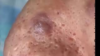 Pimples Popping On Nose Part 1 [upl. by Nuawd]