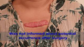 Chest Keloids  Mistakes to Avoid [upl. by Yelnoc]