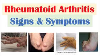 Rheumatoid Arthritis RA Signs amp Symptoms amp Associated Complications [upl. by Cown]