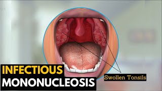 Infectious Mononucleosis Mono  EpsteinBarr Virus Transmission Symptoms Diagnosis Treatment [upl. by Burley]