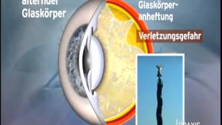 Glaskörpertrübungen im Auge [upl. by Marquita90]