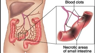 Mesenteric Ischemia [upl. by Brinn]