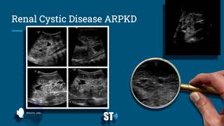 Renal Cysts Ultrasound [upl. by Kuebbing]