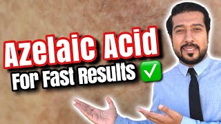 Azelaic Acid for Melasma  How to Use Azelaic Acid for SUCCESS 🏆 [upl. by Llewop196]