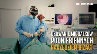 Usuwanie migdałków podniebiennych narzędziem BiZact [upl. by Vrablik]