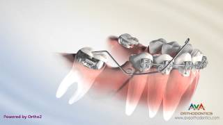 Orthodontic Treatment for Molar Uprighting  Cantilever Spring [upl. by Ahsieat95]