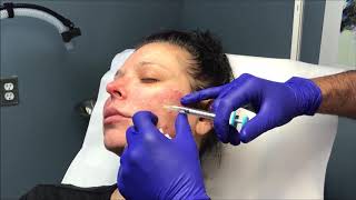 Dr Nino Kuzmar Injects Female Patient with Juvederm Volite SKIN HYDRATOR [upl. by Sedinoel188]