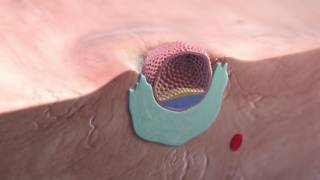 Endometrial Cancer and Hyperplasia for USMLE [upl. by Steinway]