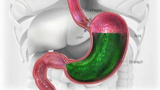 Natural Remedies for GERD Gastroesophageal Reflux Disease  Dr Berg [upl. by Elleinnad21]