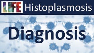 Histoplasmosis epidemiology amp diagnosis [upl. by Yelnats]