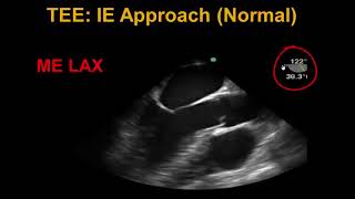 Transesophageal Echocardiography Infective Endocarditis [upl. by Harness]