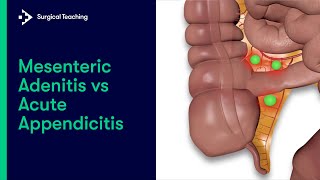 Mesenteric Adenitis vs Appendicitis  How to tell the difference [upl. by Horgan]