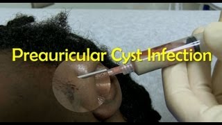 Preauricular Cyst Infection Management [upl. by Boggers]