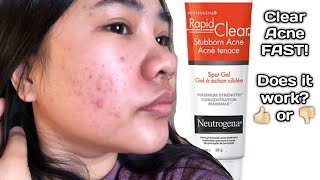 Neutrogena Rapid Clear Stubborn Acne Spot Gel Does it work [upl. by Breanne829]