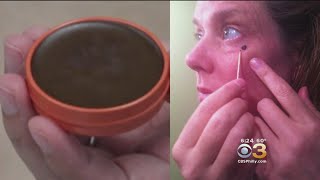 Doctors Warn Against Unproven Skin Treatment Called Black Salve [upl. by Aitnauq128]