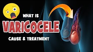 What is Varicocele  Cause amp Treatment [upl. by Oni]