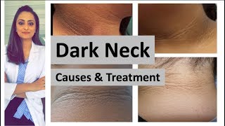 dark neck  causes treatment  Home remedies  Dermatologist Dr Aanchal Panth [upl. by Atidnan45]