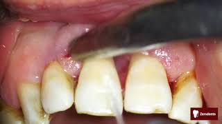 Advanced periodontal disease [upl. by Naval238]