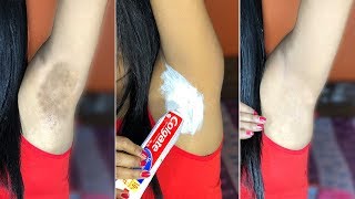 IN 5 MINUTES LIGHTENING DARK UNDERARM WITH COLGATE TOOTHPASTE [upl. by Asenaj]