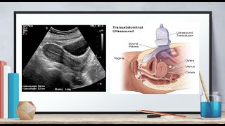 Ultrasound of normal early pregnancy [upl. by Nauqas]