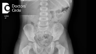 How to diagnose Intussusception  Dr Nagaraj B Puttaswamy [upl. by Hartwell]