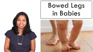 Bowed Legs in Babies – Reason amp Cure [upl. by Armillia]