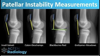 Patellar Instability  What and How to Measure [upl. by Pauly]