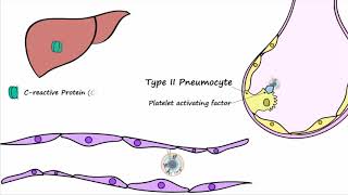 Bacterial Pneumonia  Pathogenesis [upl. by Michel]