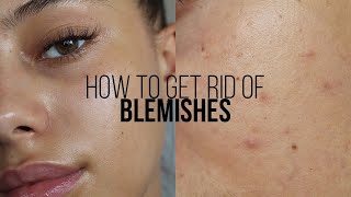 HOW TO GET RID OF BLEMISHES IN 3 DAYS  Jessicvpimentel [upl. by Moyra186]