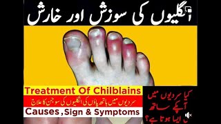 Chilblains  Treatment of Chilblains [upl. by Juakn]