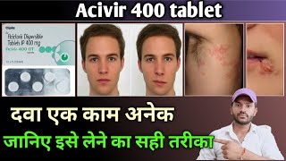 Acivir 400dt tablet uses in hindi [upl. by Virgy]