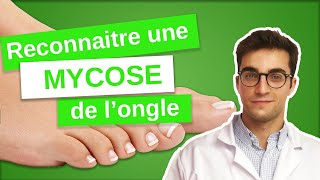 Savoir RECONNAÎTRE une MYCOSE de longle  Onychomycose 13 [upl. by Rehpotisrhc]