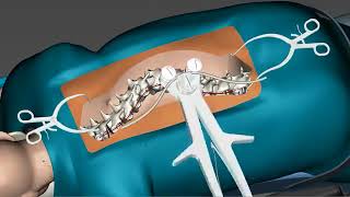 Spinal Curvature Surgery 3D [upl. by Hereld]