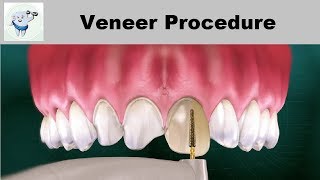 Dental Veneers Procedure Step by step [upl. by Jaymee674]