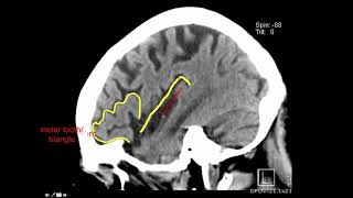 Introduction to Brain Surface Anatomy [upl. by Drofnil]