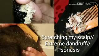 Scratching my scalp Extreme dandruff psoriasis [upl. by Rod]