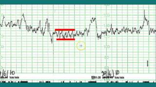 Ctg interpretation  Normal CTG [upl. by Dnomyad873]