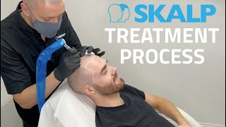 Skalp® Scalp Micropigmentation Treatment Process [upl. by Aetnuahs]