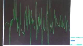 Myopathy EMG changes explained [upl. by Anhoj]