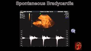 Fetal Echocardiograph Common Fetal Arrhythmias [upl. by Nalyk]