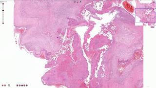 Infective Endocarditis  Histopathology [upl. by Lyman]