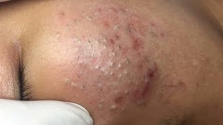 How To Remove Blackheads And Whiteheads On Face Easy 61 ✦ Dr Laelia ✦ [upl. by Guthrie695]