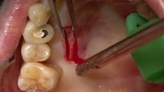 Mixed EpithelialConnective tissue graft harvesting from palate [upl. by Cirted]