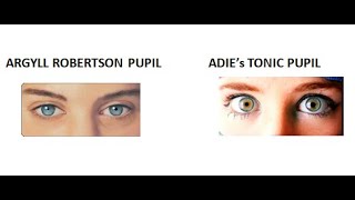 Ophthalmology 326 Argyll robertson pupil Adies tonic pupil neurosyphilis difference pilocarpine test [upl. by Felty]