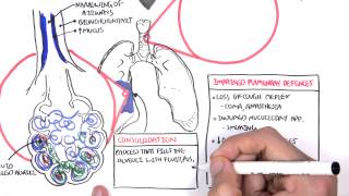 PART I  Pneumonia Overview Lobar and Bronchopneumonia [upl. by Lindie]